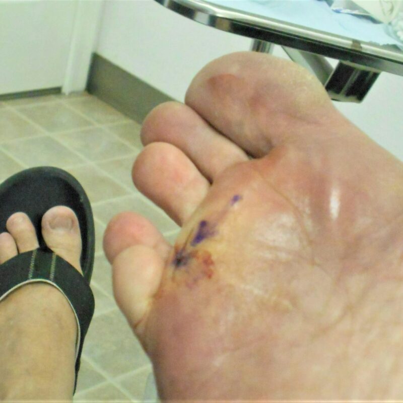 MELANOMA! Caucasian Woman with Melanoma Skin Cancer on Her Foot Being Treated by Dermatologist!
